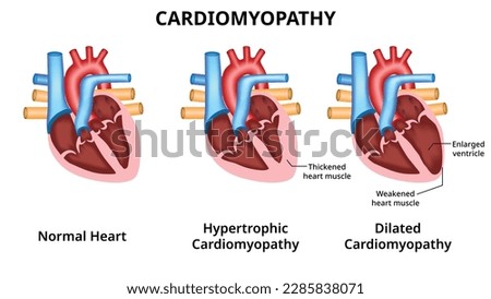 HYPERTROPHIC CARDIOMYOPATHY Stock Vector Images Avopix