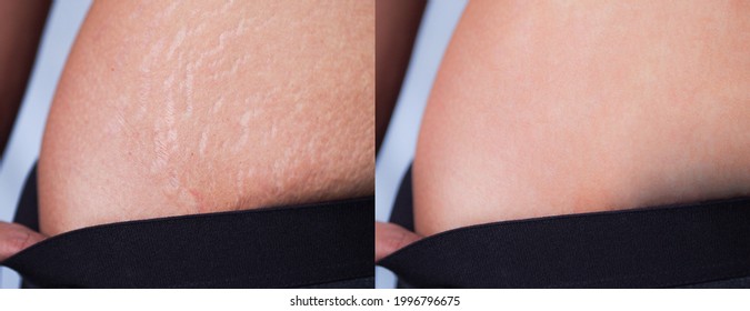 Image Before After Skin Stretch Marks Stock Photo 1996796675 Shutterstock