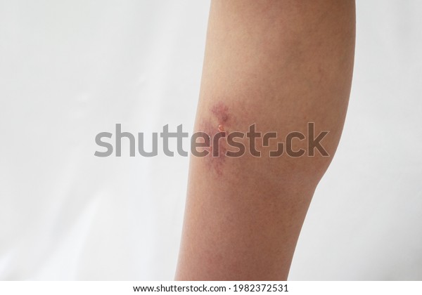 Leg Symptom Bacterial Cellulitis Which Has Stock Photo 1982372531