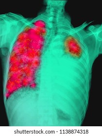 Lung Cancer Pleural Effusion Stock Photo Edit Now 1138874318