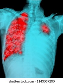 Lung Cancer Pleural Effusion 스톡 사진 1143069200 Shutterstock