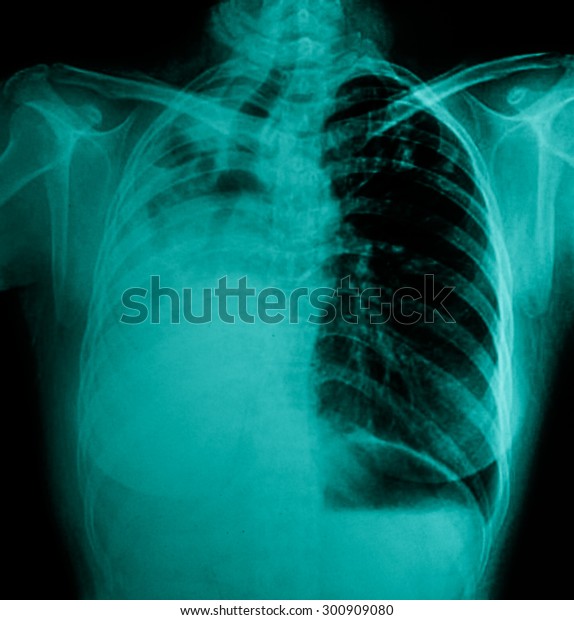 Lung Cancer Pleural Effusion Stock Photo Edit Now 300909080