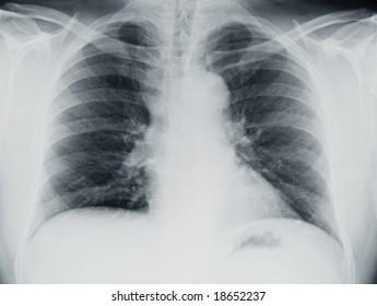 Chest Xray Film Patient Lobar Pneumonia Stock Photo Edit Now