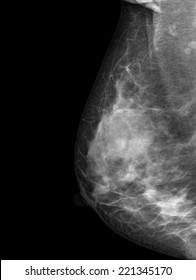 Mammogram Radio Imaging Breast Cancer Diagnosis Stock Photo