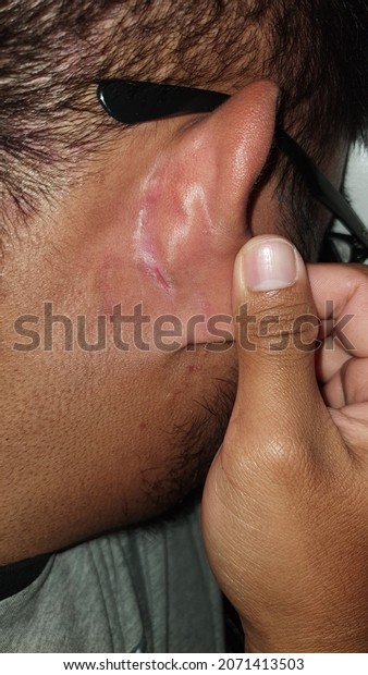 Man Fissure Wound Behind His Ear Stock Photo 2071413503 Shutterstock