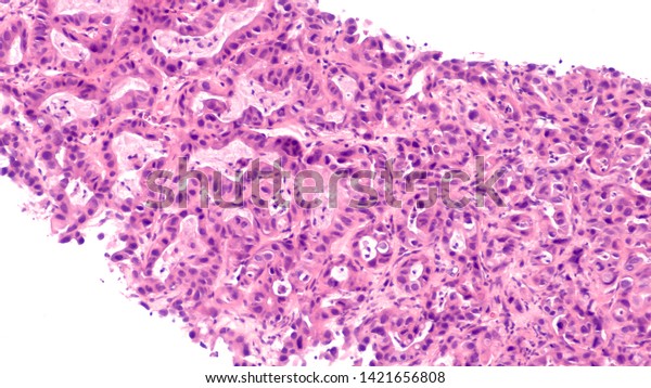 Microscopic Image Core Biopsy Liver Showing Stock Photo 1421656808