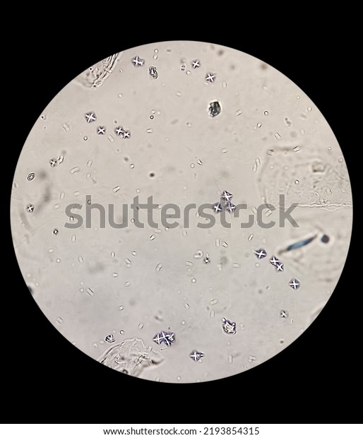 Microscopic Image Showing Calcium Oxalate Crystals Stock Photo