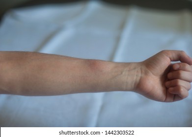 Mosquito Bite On Human Skin Isolated Stock Photo 1442303522 Shutterstock