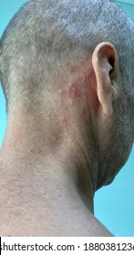 Erythematous Papules Images Stock Photos Vectors Shutterstock