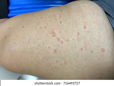 47 Erythematous Papules Images Stock Photos Vectors Shutterstock