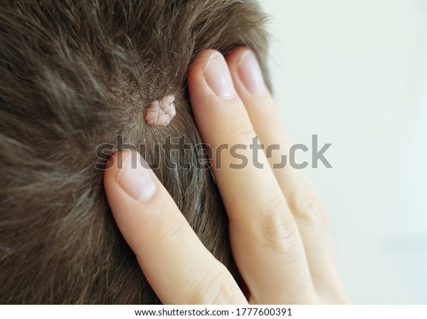 Naevus Sebaceus On Human Head Stock Photo Edit Now