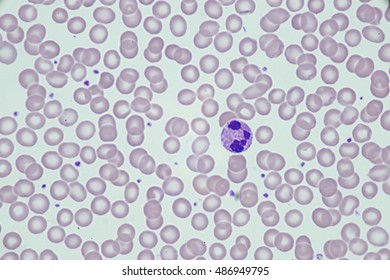 Blood Smear Under Microscope Present Lymphocyte Foto De Stock Editar