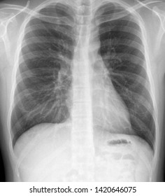 Normal Chest Xray Pa Upright Position Foto Stok Shutterstock