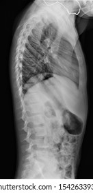 Normal Radiograph Thoracic Lumbar Spine Lateral Stock Photo