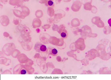 Rouleaux Formation On Blood Smear Shutterstock