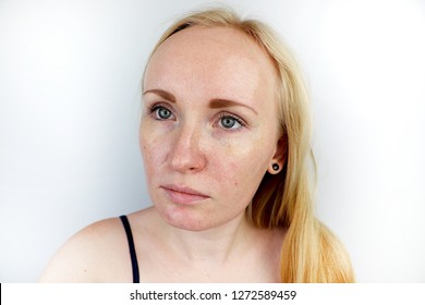 Oily Problem Skin Portrait Blonde Girl Stock Photo