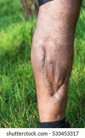 Similar Images Stock Photos Vectors Of Old Scar Of Leg Injury From