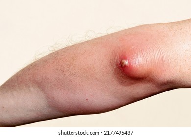 Olecranon Bursitis Abscess Elbow Inflammation Infection Stock Photo