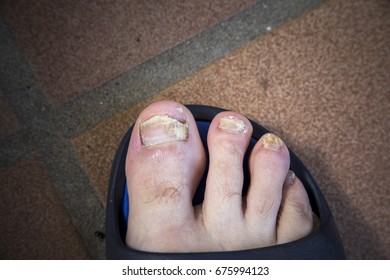 Onychomycosis Fungal Nail Infection Two Feet Stock Photo