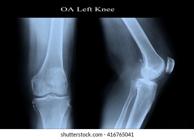 Film Xray Knee Radiograph Show Rheumatoid Stock Photo 1501182716