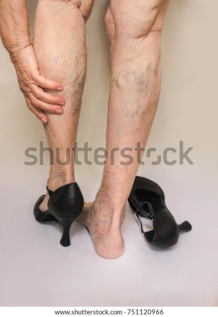 Painful Varicose Spider Veins On Female Stock Photo Edit Now 751120966