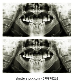 Panoramic Dental Xray Scan Human Teeth Stock Photo 399978262 Shutterstock