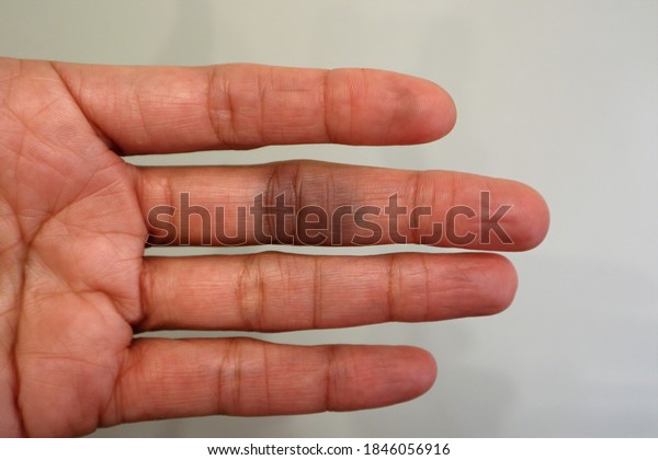 Paroxysmal Hand Hematoma Affecting Middle Finger Stock Photo Edit Now