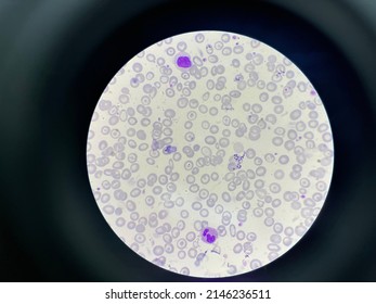 Pbs Peripheral Blood Smear Thalassemia Trait Foto Stok