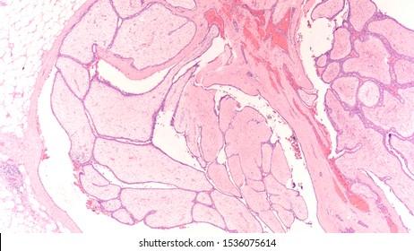 Photomicrograph Showing Histology Benign Phyllodes Tumor Stock Photo