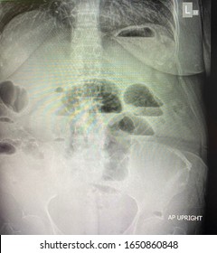 Picture Film Xray Abdomen Patient Who Stock Photo Edit Now