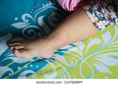 Pityriasis Rosea On Baby Girl Skin Foto Stock Shutterstock