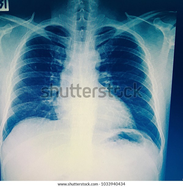 Pulmonary Tuberculosis Tb Chest Xray Show Shutterstock