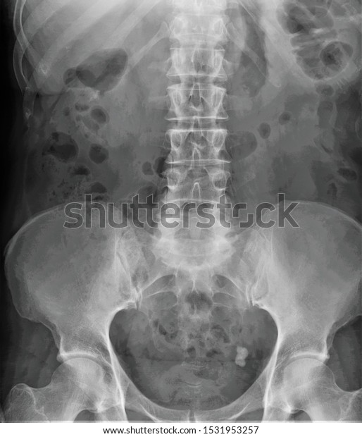 Radiograph Lumbar Spine Direct Projection Stock Photo