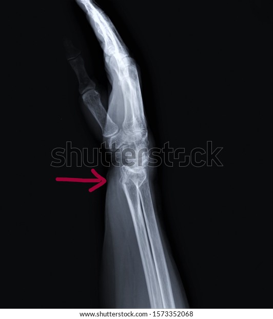 Radiography Forearm Wrist Bones Fracture Distal Stock Photo Edit Now