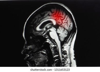 Sagittal Cut Magnetic Resonance Image Mri Stock Photo