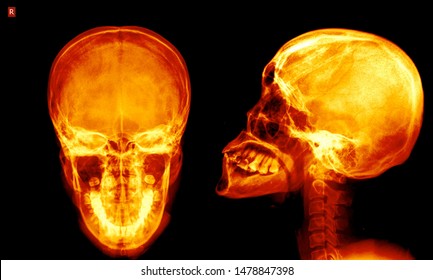 Schedel Ap Radiograph Skull Head Neck Foto De Stock Shutterstock