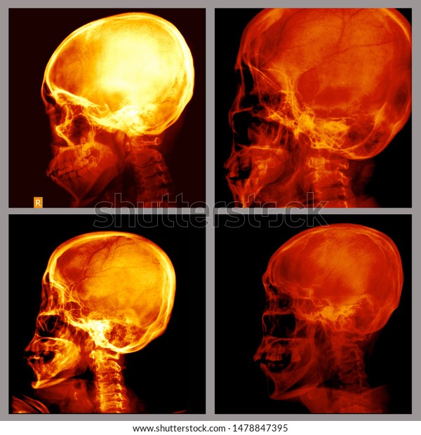 Schedel Ap Radiograph Skull Head Neck Stock Photo Shutterstock