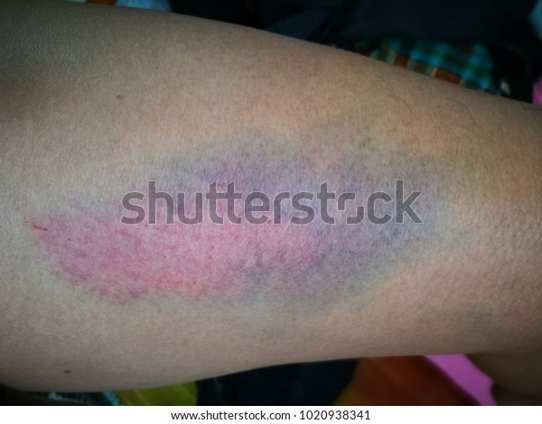 Skin Disease Lesion Ecchymosis Vasculitis Nursing Stock Photo