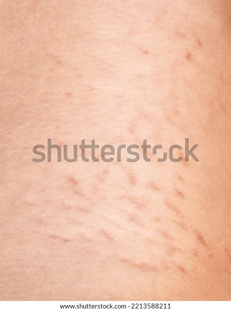 Skin Stretch Marks On Womans Body Stock Photo Shutterstock