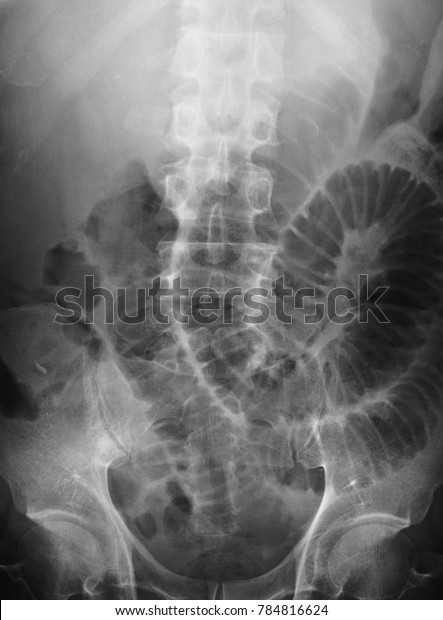 Small Bowel Obstruction On Abdominal Xray Stock Photo Edit Now