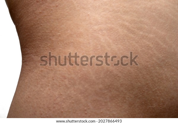 Стоковая фотография 2027866493 Stretch Marks On Womans Buttocks Skin