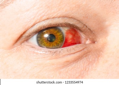 Subconjunctival Hemorrhage Hyposphagma Closeup Womans Face Stock Photo