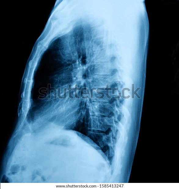 Thoracic Abdominal Cavity Xray Film Stock Photo Edit Now 1585413247