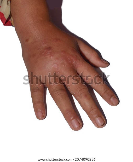 Unilateral Edema Scabies Upper Limb Swollen Stock Photo Edit Now