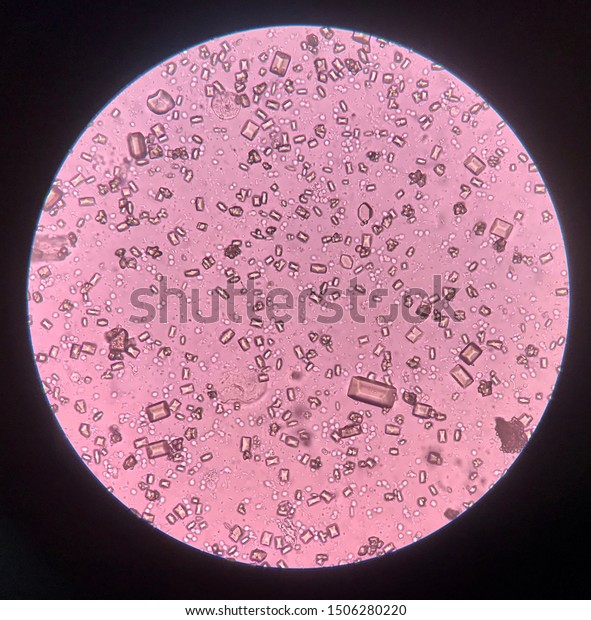 Urine Analysis Finding Microscope Show Crystal Stock Photo Edit Now