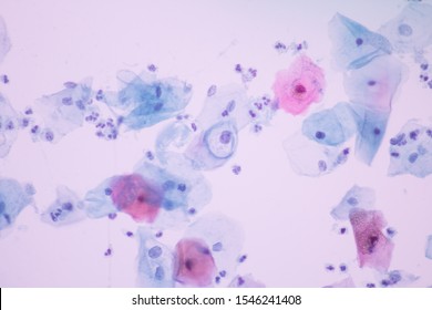 Candida Albicans Infecion Pap Smearview Microscopicmedical Foto Stock