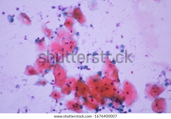 View Microscopic Trichomonas Pap Smear Slide Stock Photo Edit Now