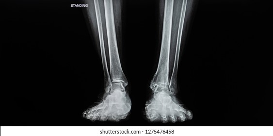 Xray Human Leg Anteroposterior Progectionfilm Shown Stock Photo Edit