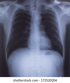 Dextrocardia Chest Xray That Shows Rare Stock Photo Edit Now 1824313724