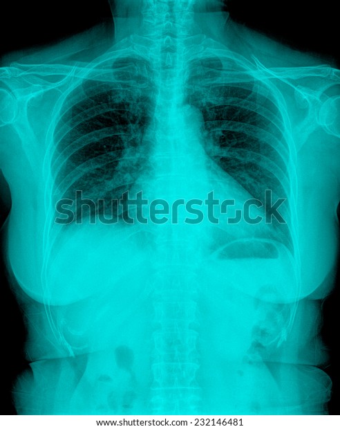 Xray Image Human Healthy Chest Mri Stock Photo 232146481 Shutterstock